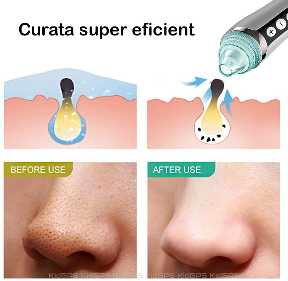blackhead remover pore vacuum